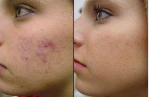 Choosing the Best Acne Scar Removal Products