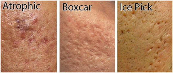 How to Get Rid Of Ice Pick Acne Scars?