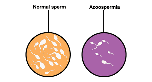 The infertility Talk – Azoospermia & its causes